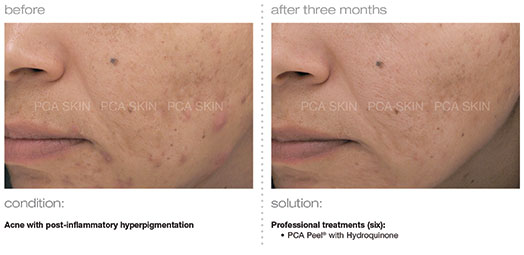 acne-with-post-inflammatory-hyperpigmentation
